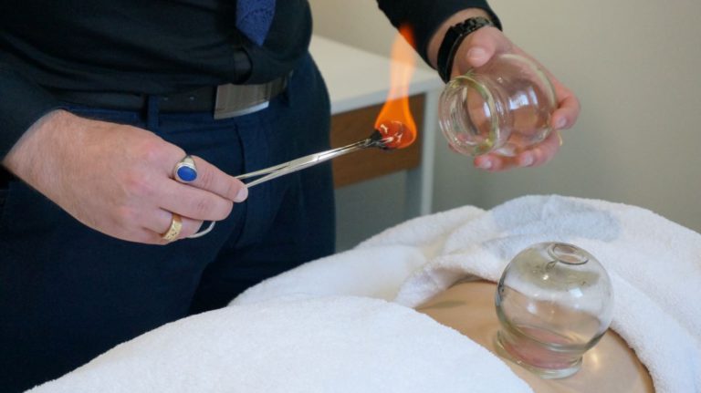 Cupping Therapy Melbourne: Discover Its Healing Benefits