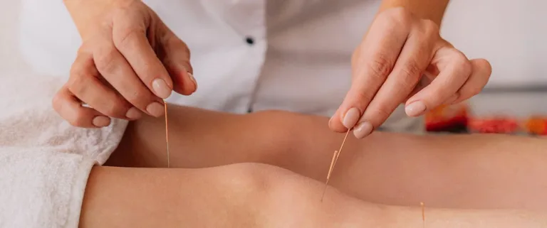 Acupuncture for Stress and Anxiety: Your Essential Guide