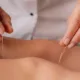 Acupuncture for Stress and Anxiety: Your Essential Guide
